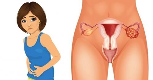 cancer ovario