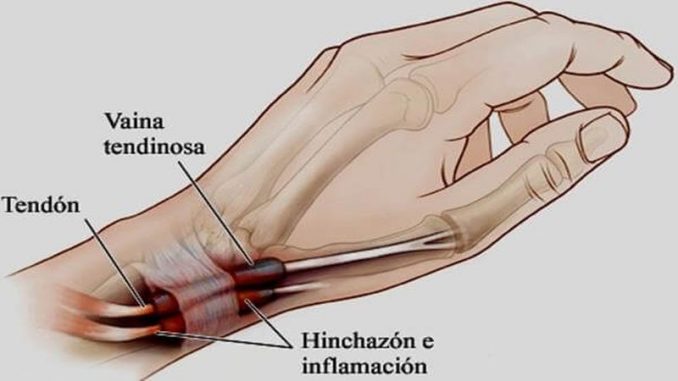 tenosinovitis-1