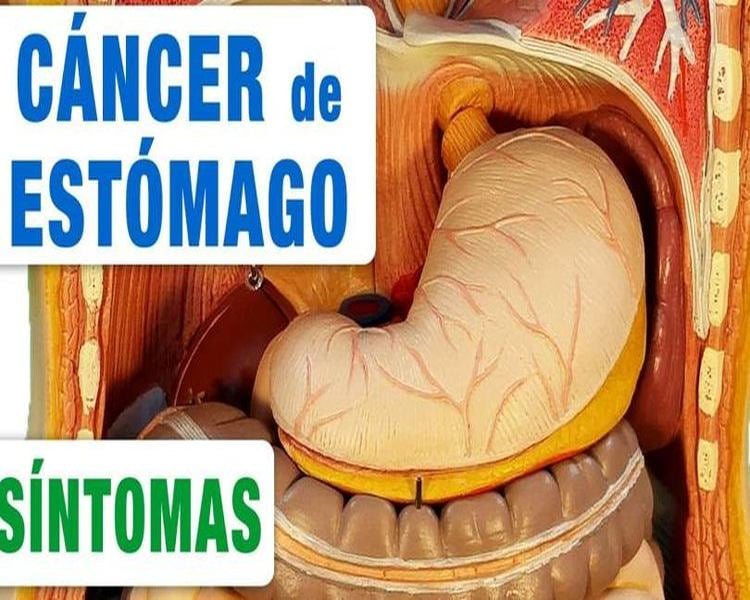 CANCER ESTOMAGO