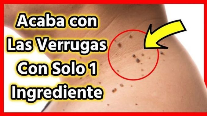 verruga1